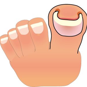 巻き爪は爪の問題？それとも足の問題？｜甲子園口よしゆき鍼灸院！