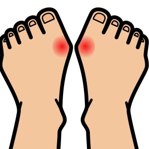 外反母趾などの足の予防・改善について！｜西宮市甲子園口よしゆき鍼灸院